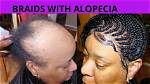 Alopecia Braiders Near Me: Finding the Right Support for Hair Loss