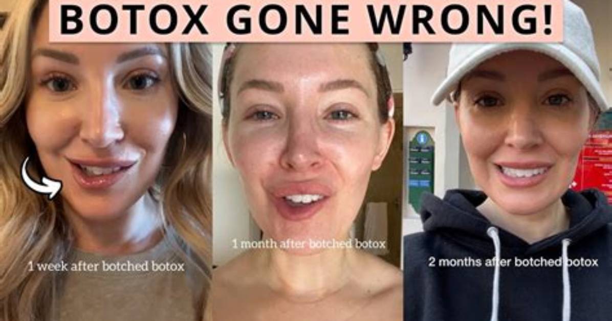 Botox Went Wrong: Understanding the Risks and Consequences