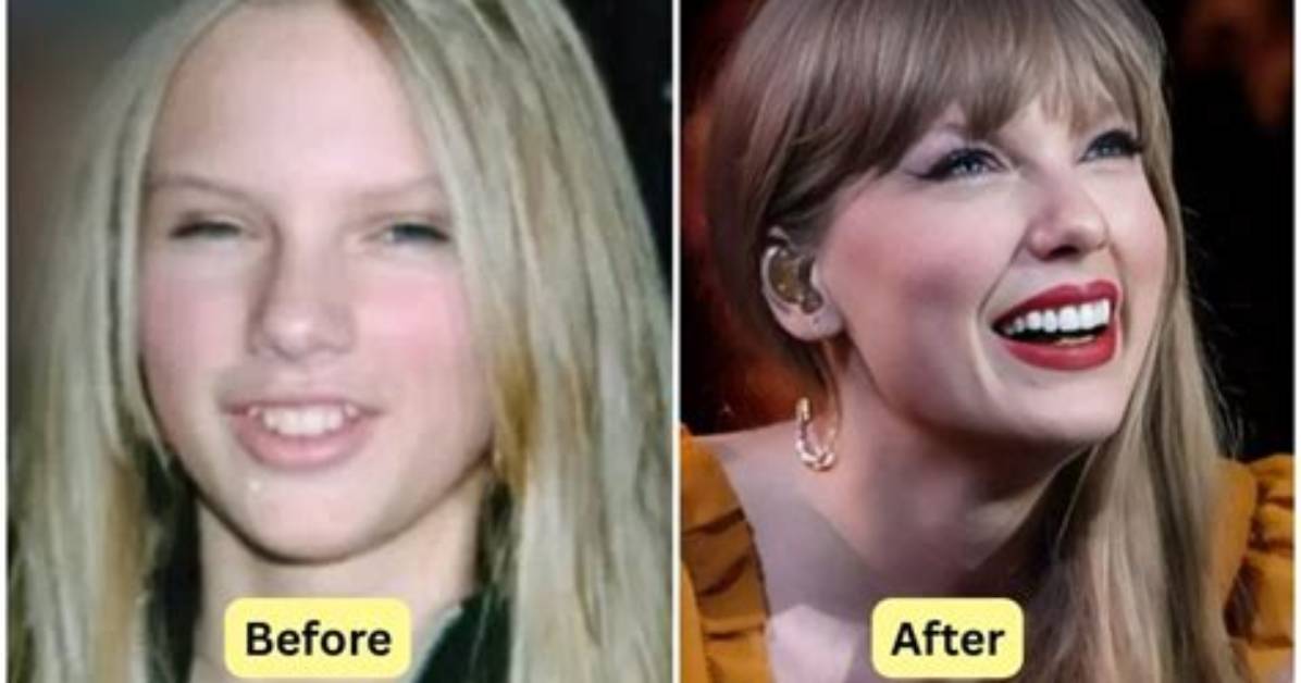 Does Taylor Swift Have Fake Teeth? or Did She Get Veneers?