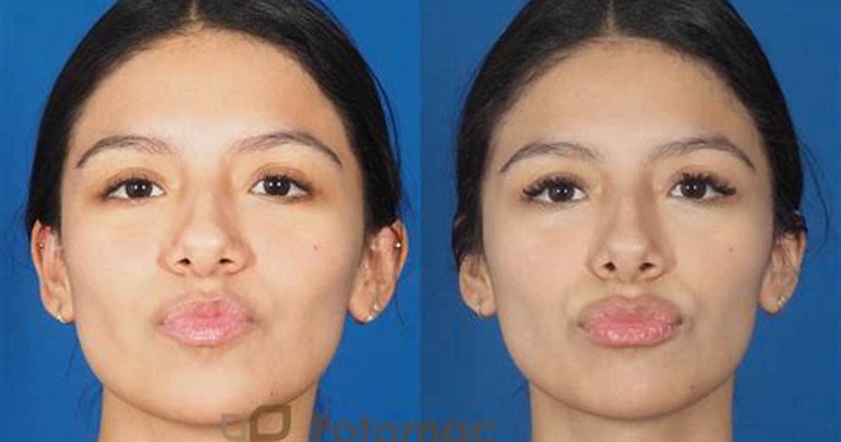 Inside Luna Blaises Plastic Surgery and Lip Fillers Rumors