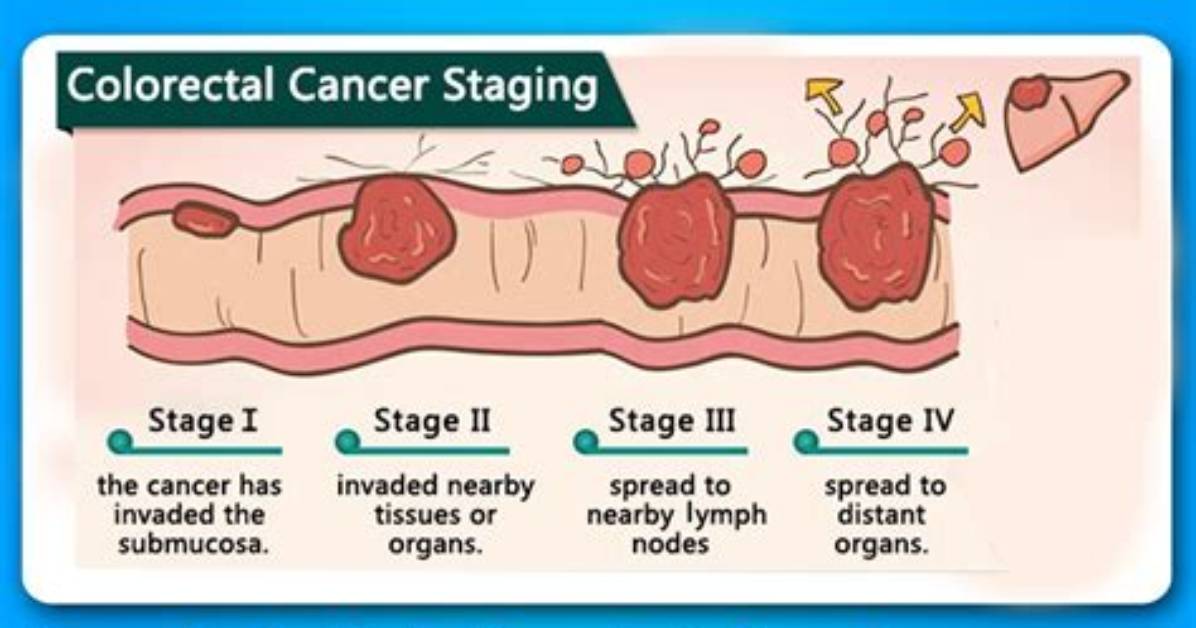 Pioneer Woman Colon Cancer Stage 4: a Comprehensive Guide