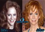 Reba Mcentires Plastic Surgery: the Truth Behind Her Ageless Beauty