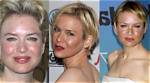 Uncover the Famous Faces with Rosacea: Celebrities with Rosacea Exposed