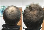 What Happened to Udonis Haslem Head? Bald Spots Leads Fans to Believe He Might Have Alopecia